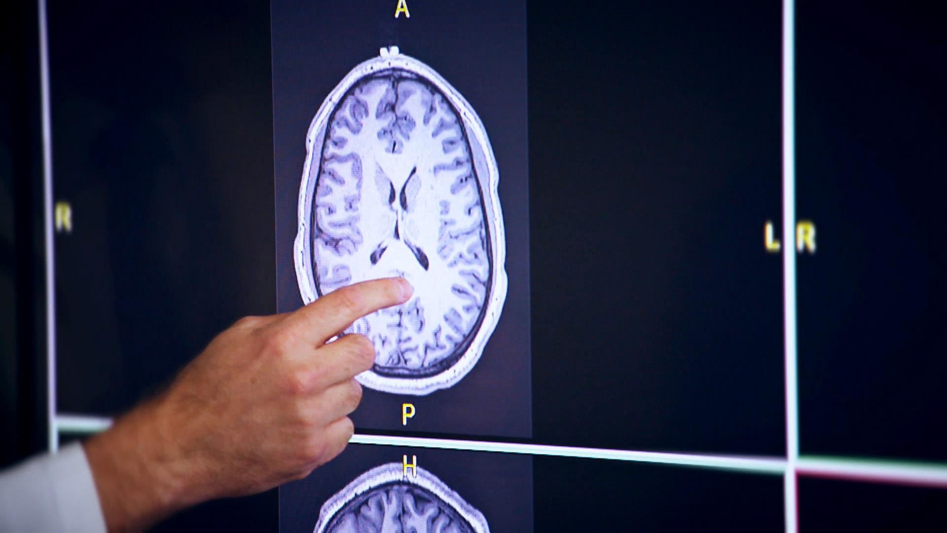 Brain disease CTE found in 87 deceased NFL players - CBS News