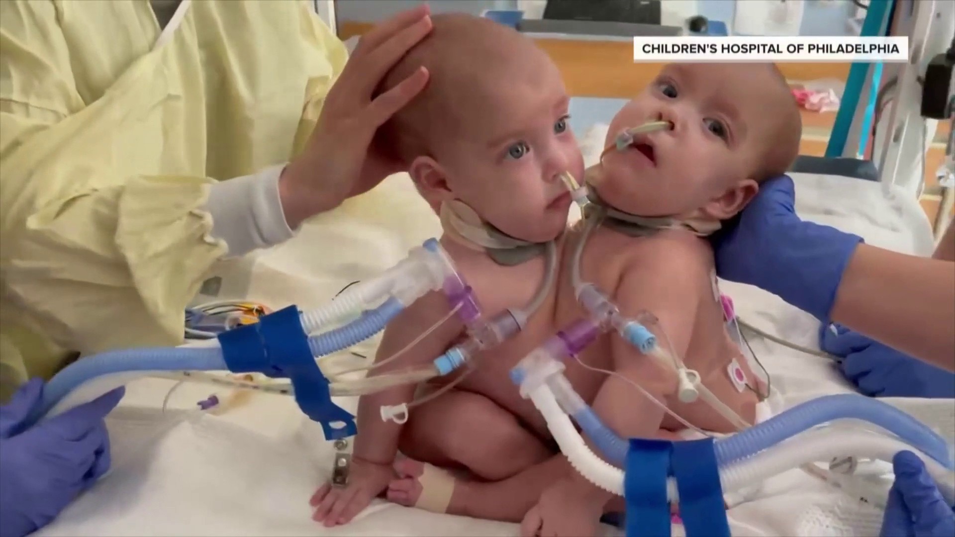 Meet the surgeon who led life-changing procedure to separate conjoined twin...