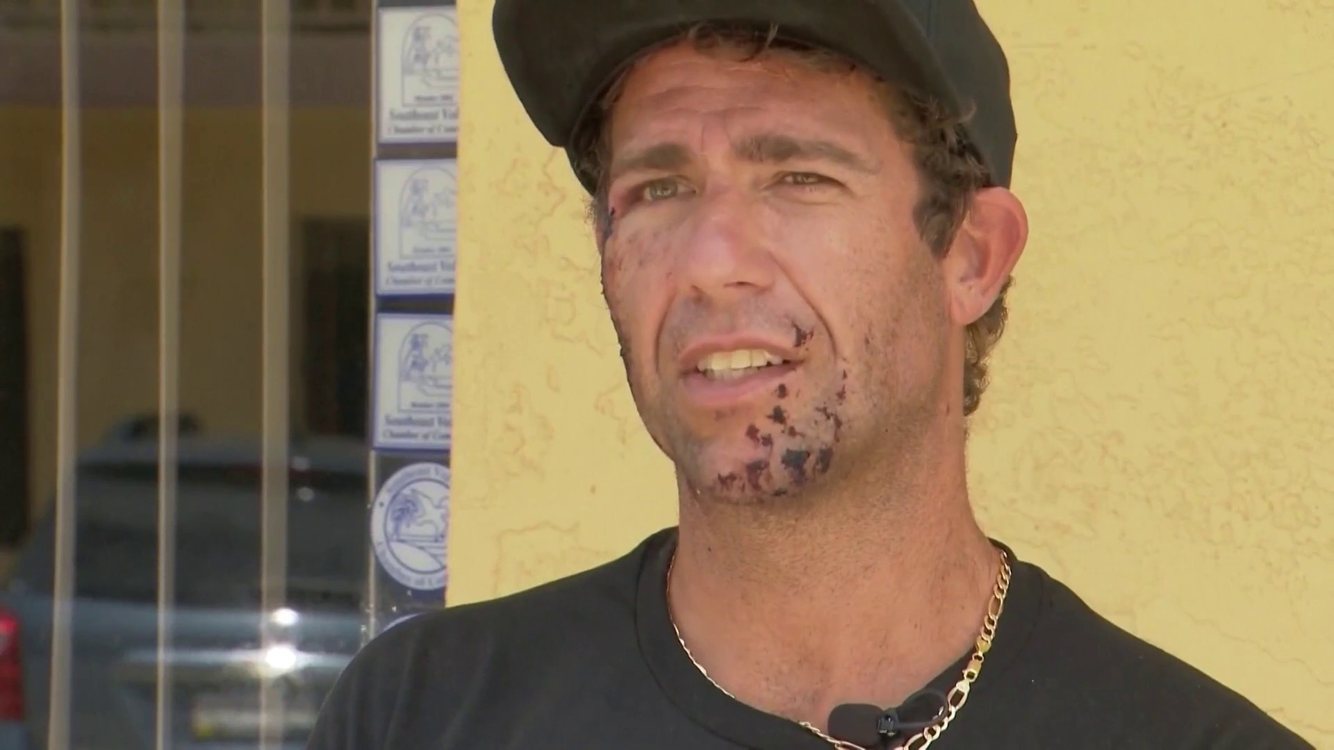 Surfer bit on the face by shark: 'It felt like a bear trap'