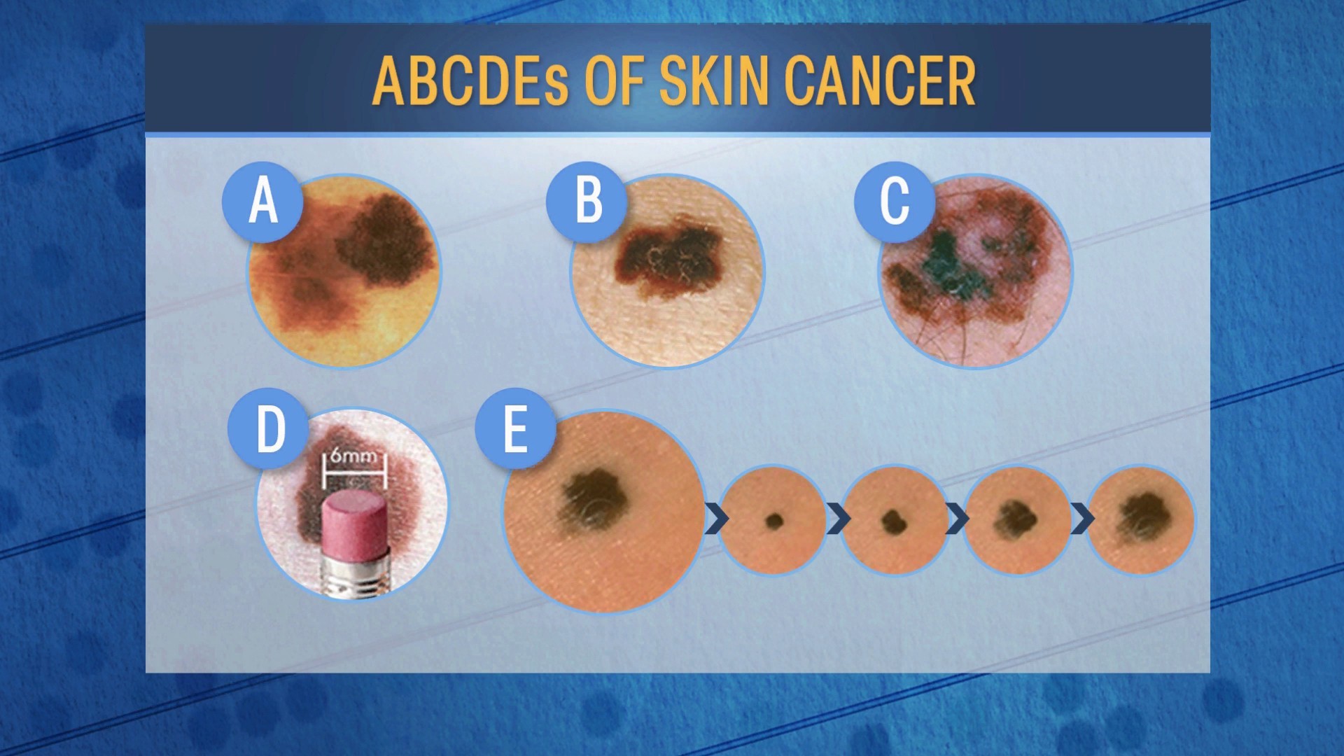 What to know about skin cancer: Self-exams, safety tips, more