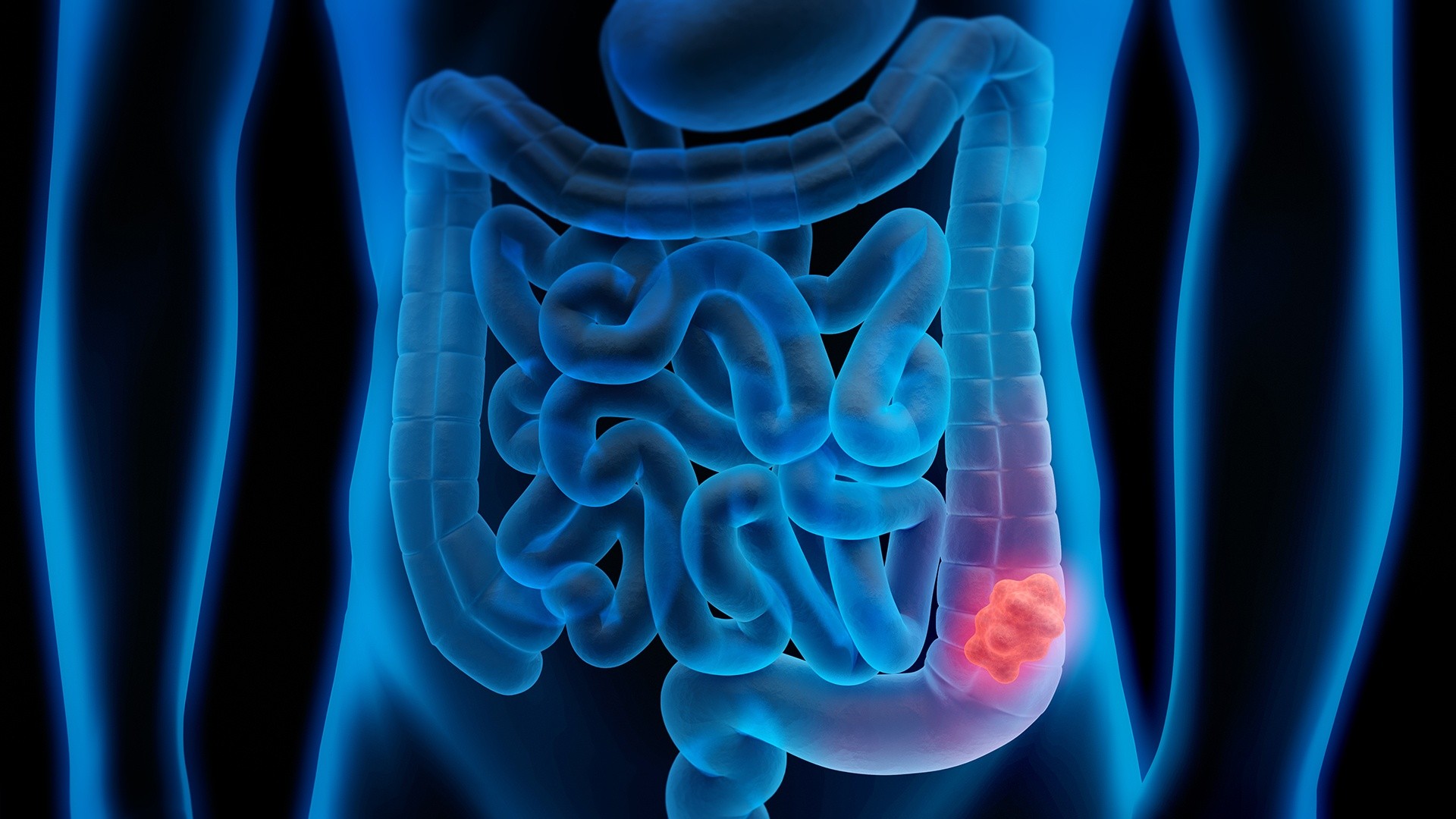 New Study Shows Promising Results in Fight Against Colon Cancer