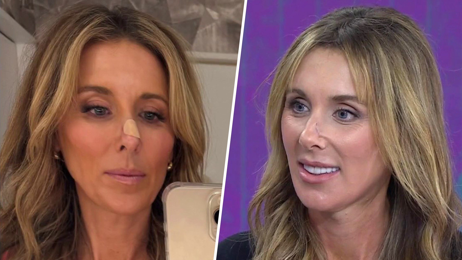 Doctor Shares What to Know About Basal Cell Carcinoma