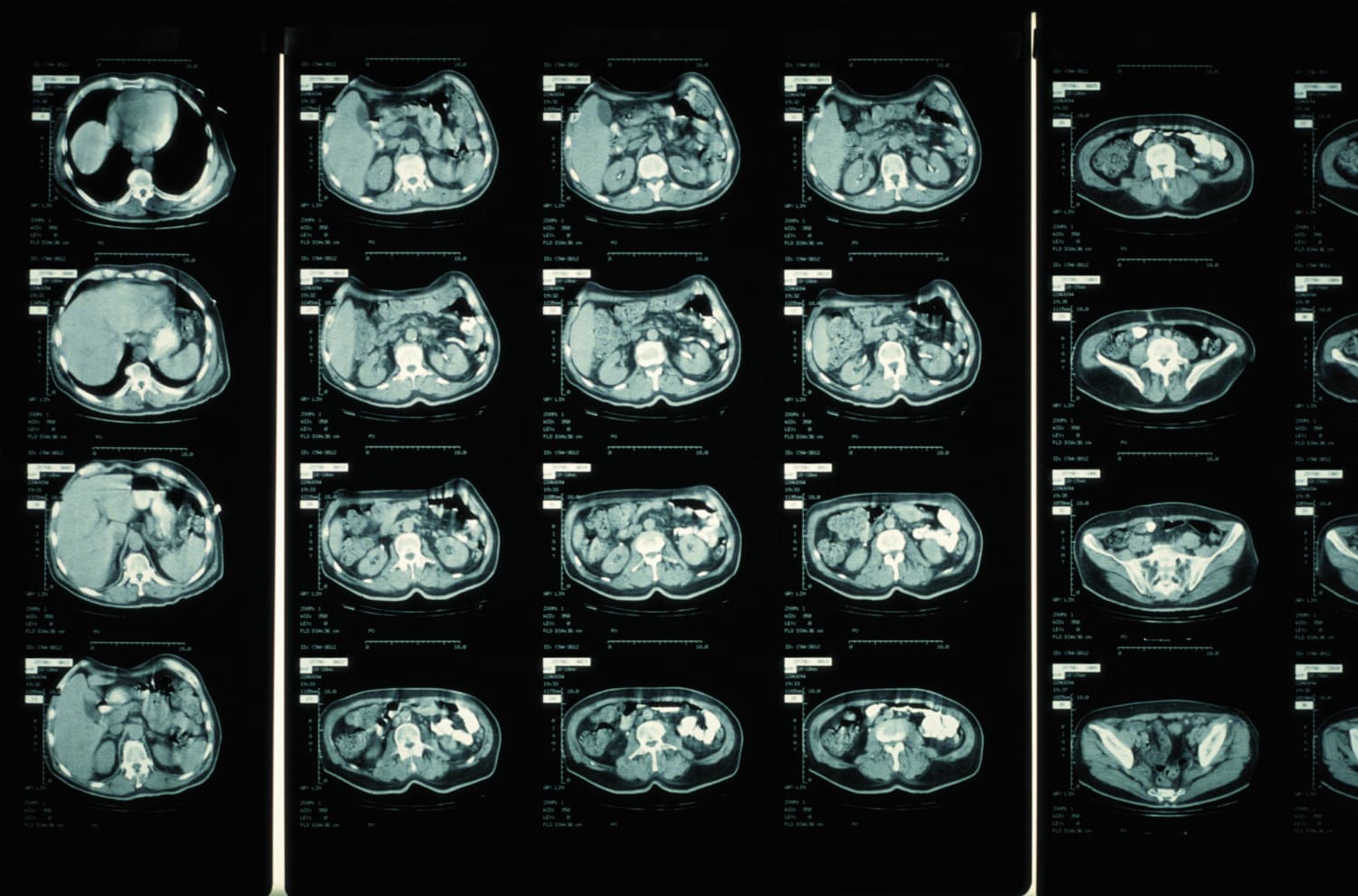 What a CT scan? What the detects how it works