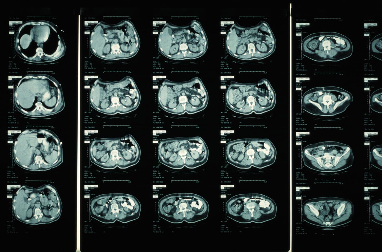 Brain Cat Scan Procedure