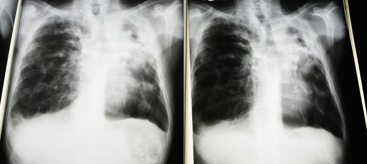 Легкие человека с туберкулезом. Рентген снимок при туберкулезе легких. Рентген легких больного туберкулезом. Туберкулез легких рентген. Снимки легких при туберкулезе.
