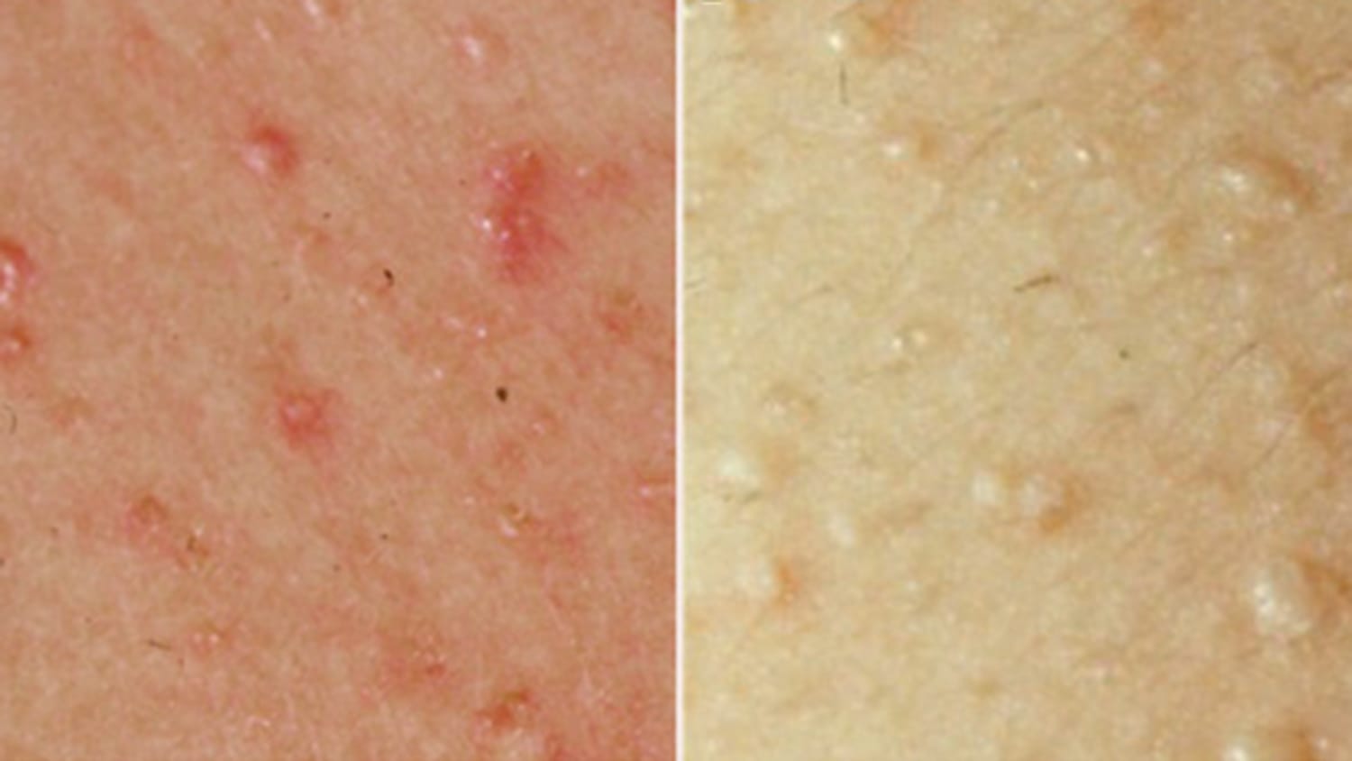 Plagued by a summer rash? How to tell if it's heat rash or something more  sinister