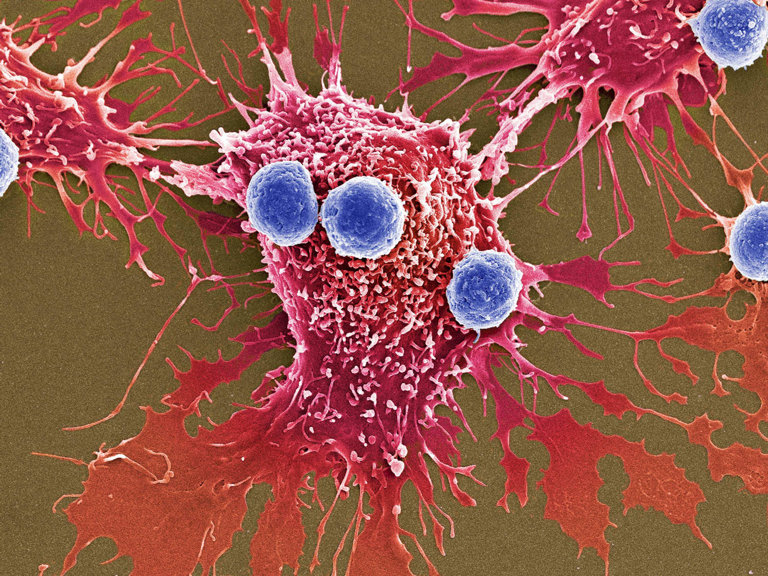 Возникновения злокачественных новообразований. Раковая клетка и т лимфоцит. Опухолевые клетки микроскоп. Раковые опухолевые клетки. Клетки злокачественной опухоли.