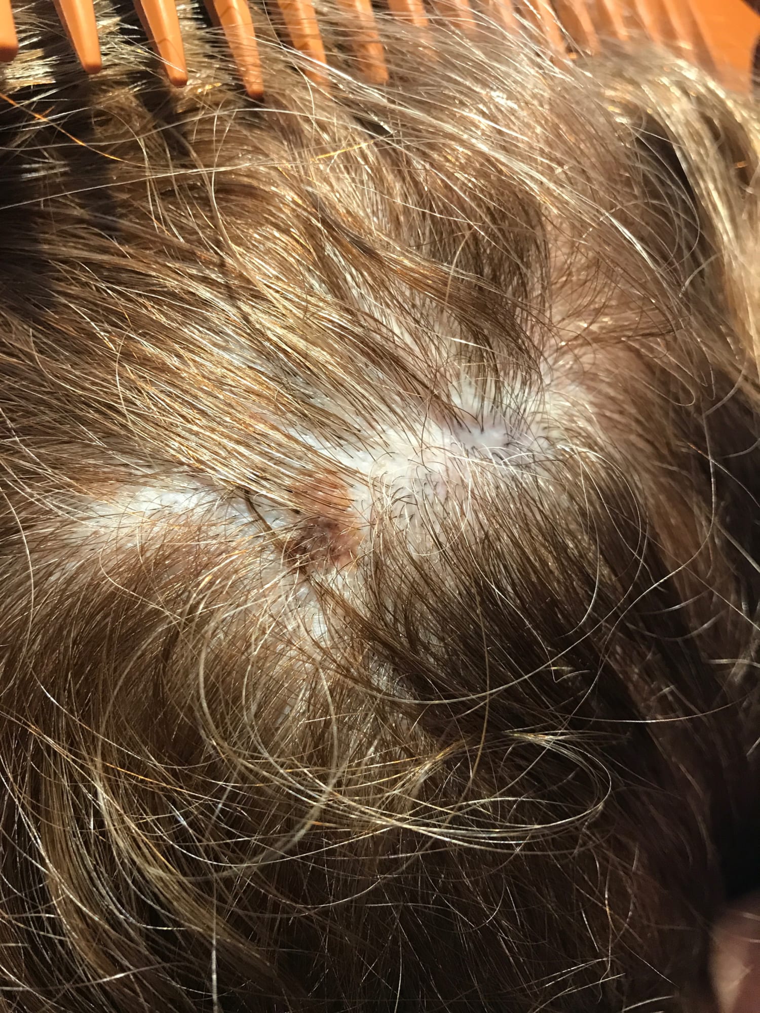 Don't forget to check your scalp for melanoma skin cancer