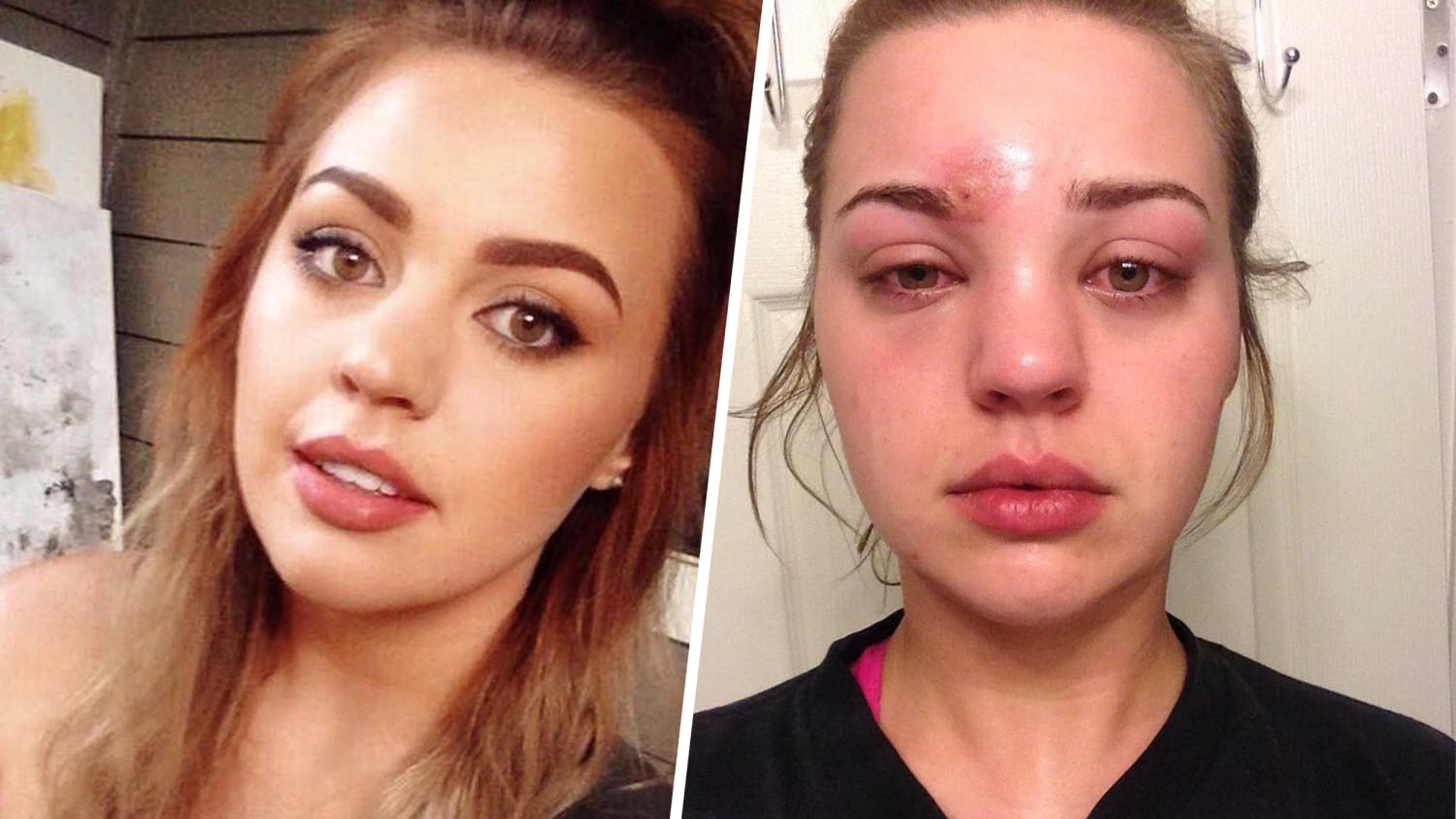 popped pimple led to a staph infection