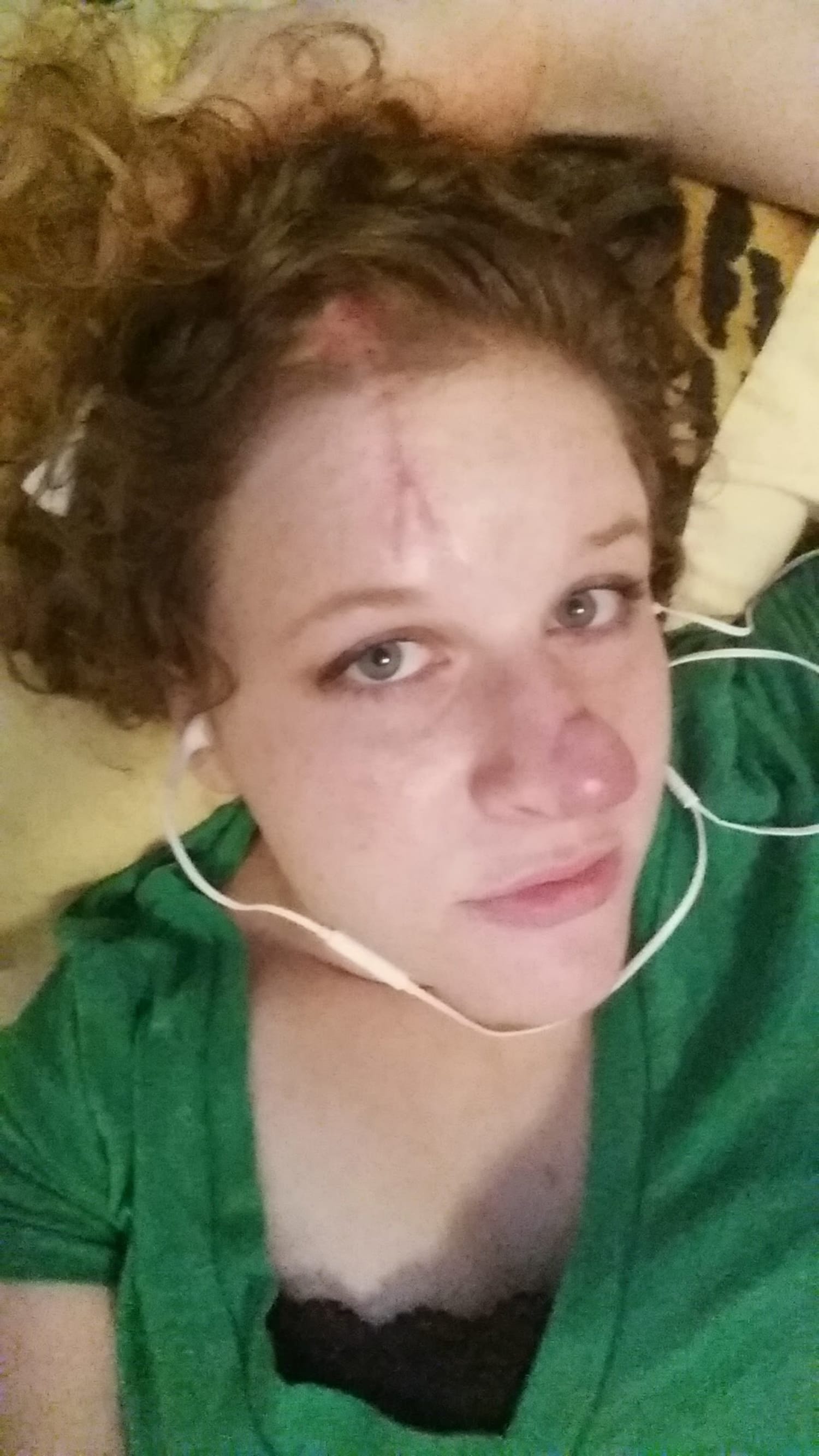Lappe beviser utilfredsstillende Skin cancer scare: She thought the red spot was a pimple