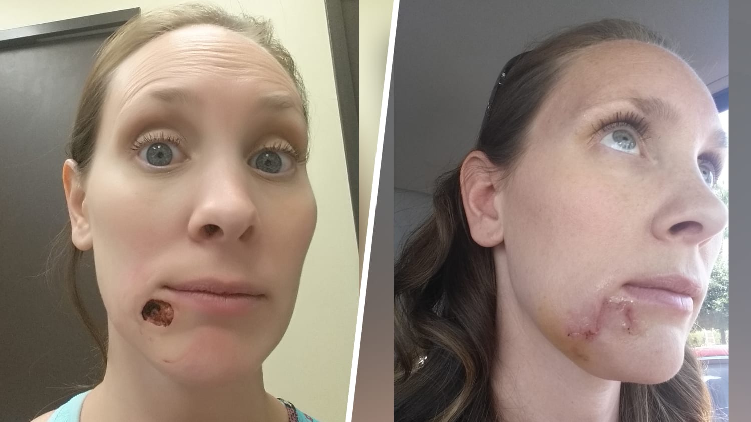 Woman Shares Story Of Pimple That Turned Out To Be Squamous Cell Carcinoma