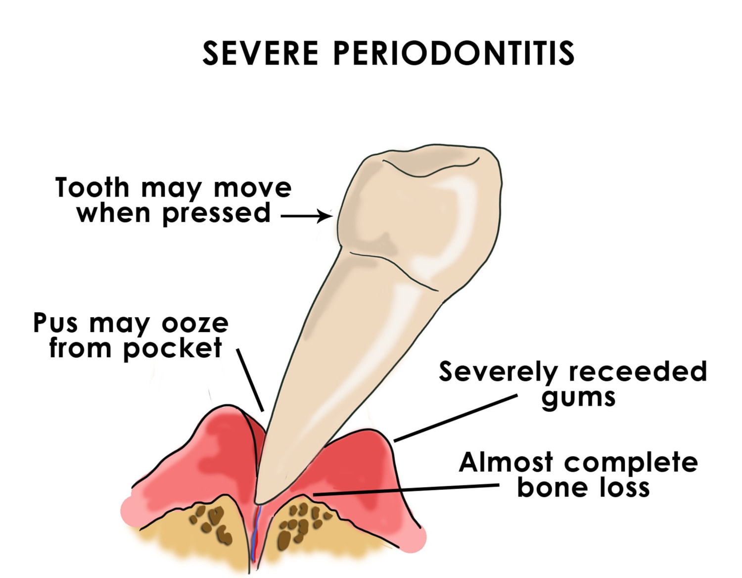 Do I Really Need a Deep Cleaning? Here's Why a Regular Cleaning Won't Cut  It — Downtown Dentist SF