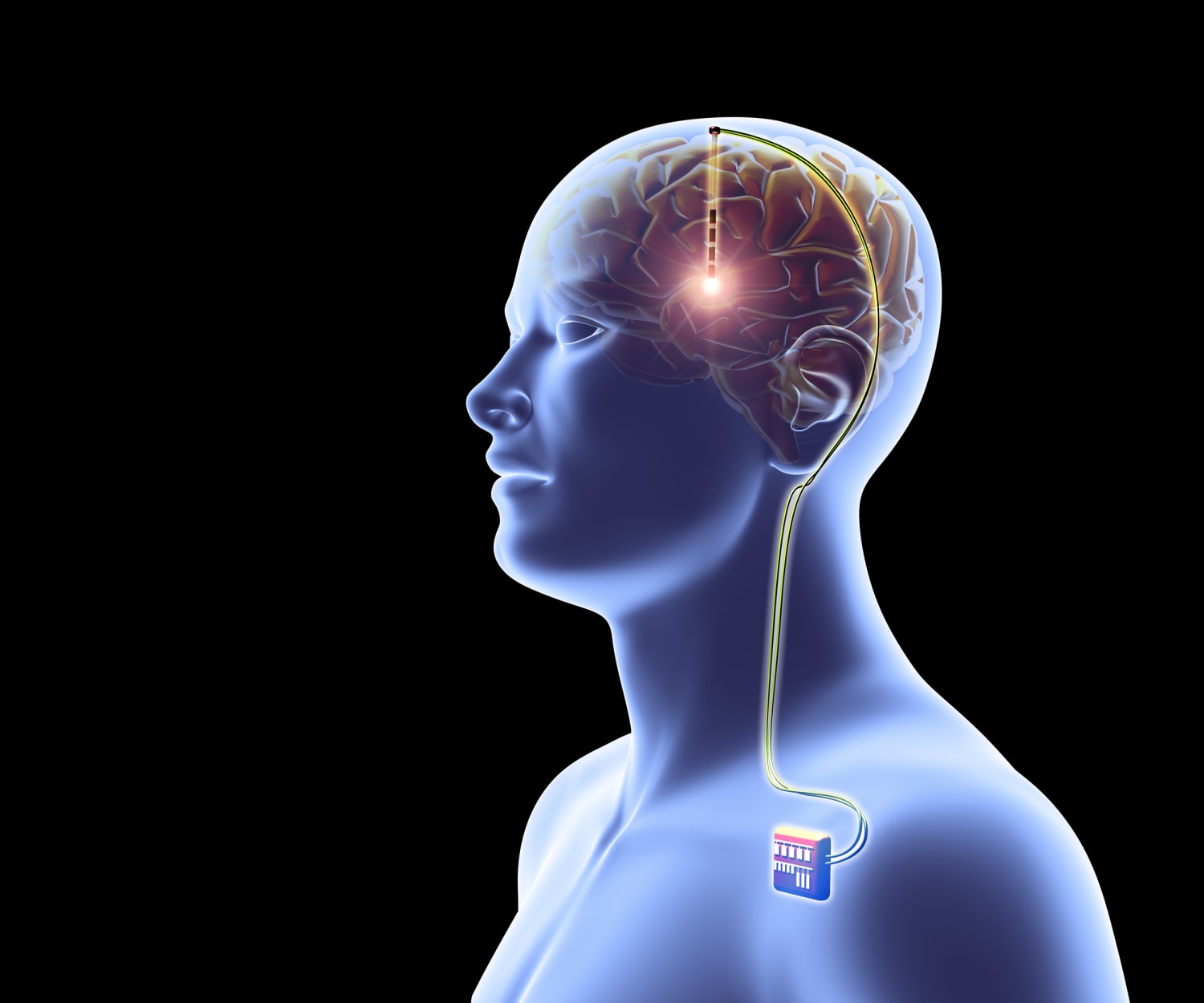 Transparent Brain Implant Can Read Deep Neural Activity From the