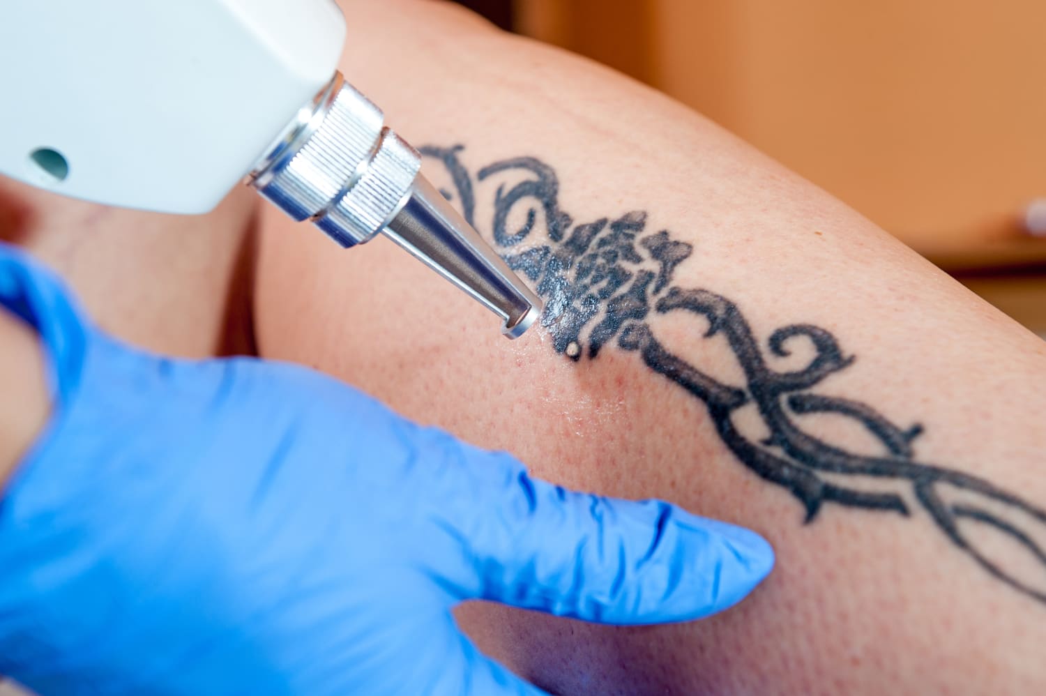 What Are Tattoo Removal Creams And Do They Work