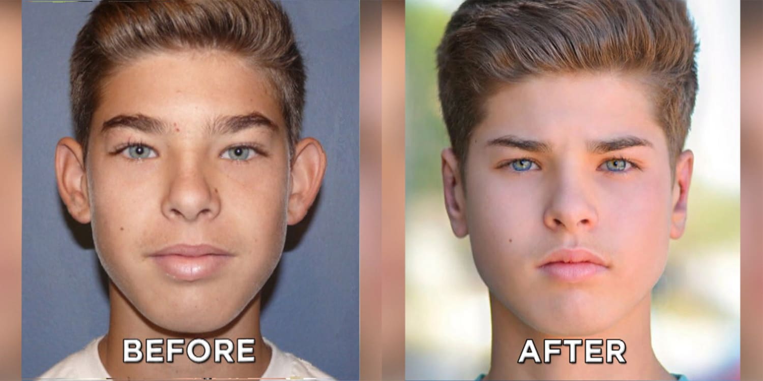 more teens turn to plastic surgery
