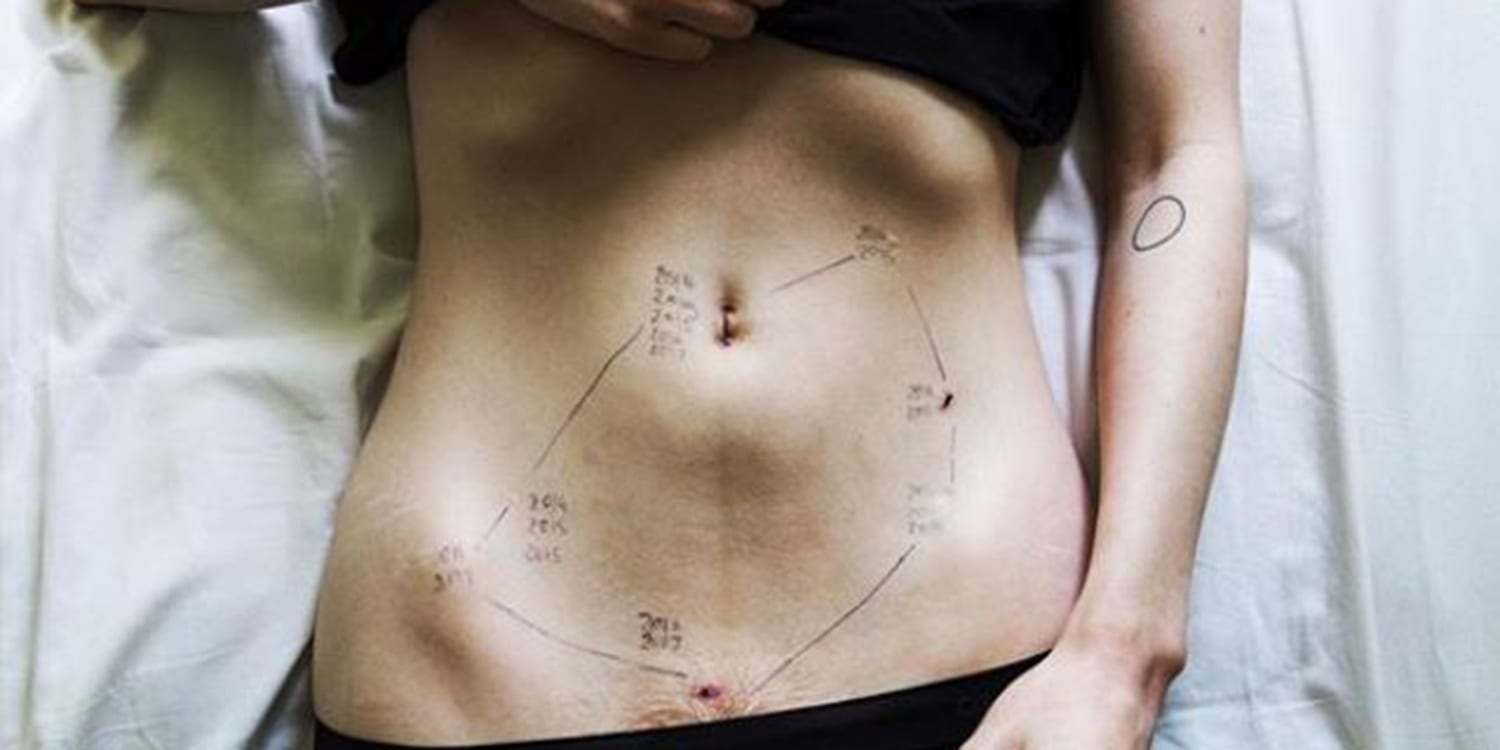 Tattoos over Tummy Tuck Scars - Ali Sajjadian, MD