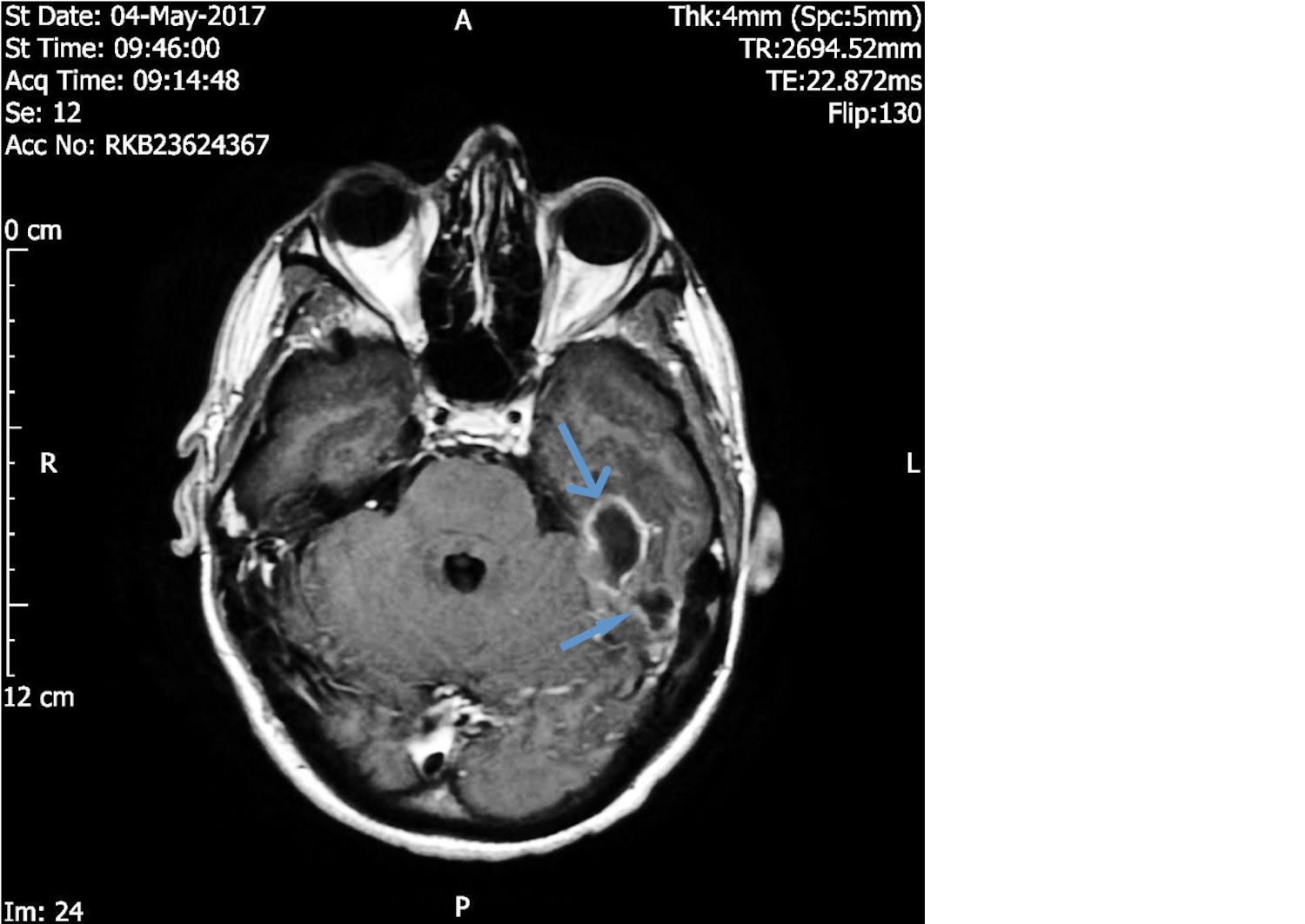 Cotton Swab Stuck In Ear Led Man To Suffer Seizures Skull Infection