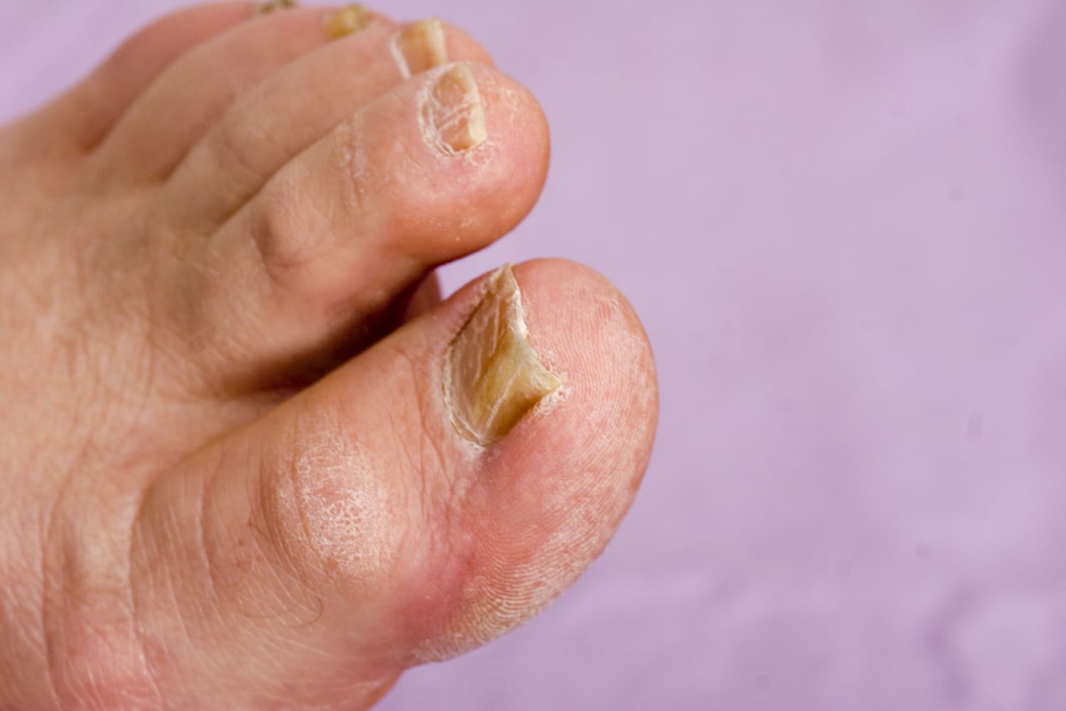 Nail Fungus on a Female Hand Finger Close-up on a Black Background. Free  Space for Text Stock Photo - Image of flesh, infection: 201928438