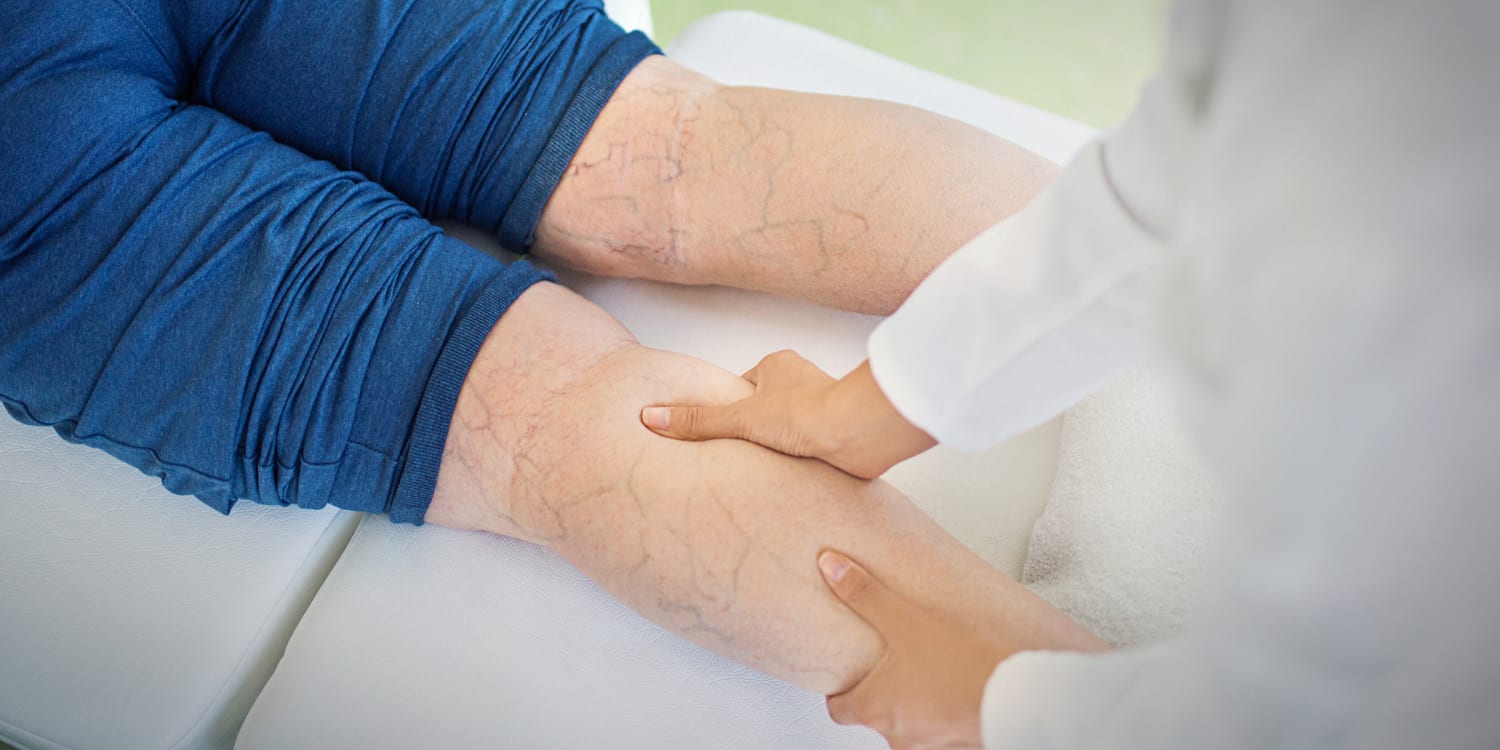 Colorado Varicose Veins Treatment