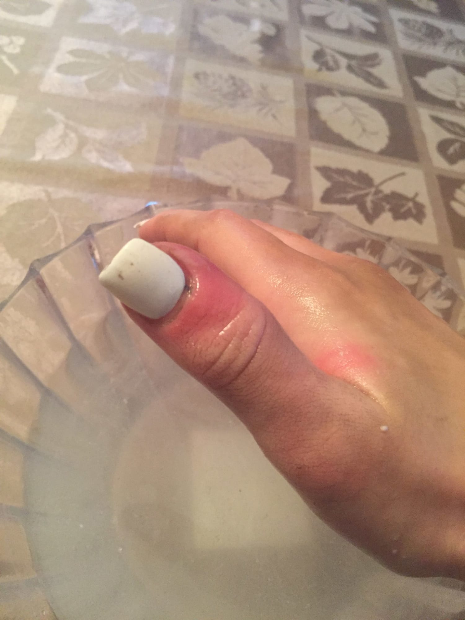 Normal Black Line Under Fingernail vs. Melanoma Streak » Scary Symptoms