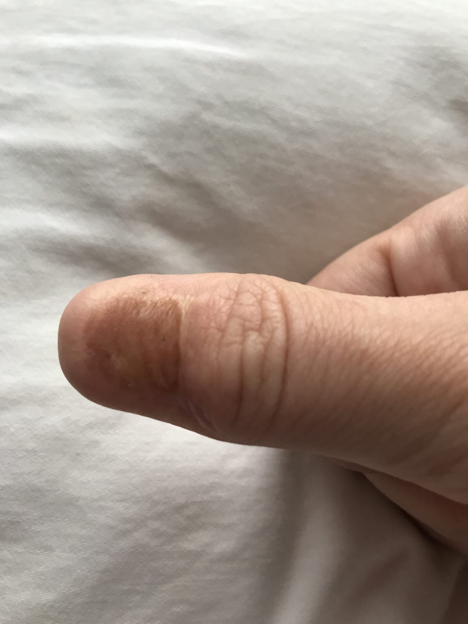 What does nail melanoma look like? Skin cancer can hide as line on nail