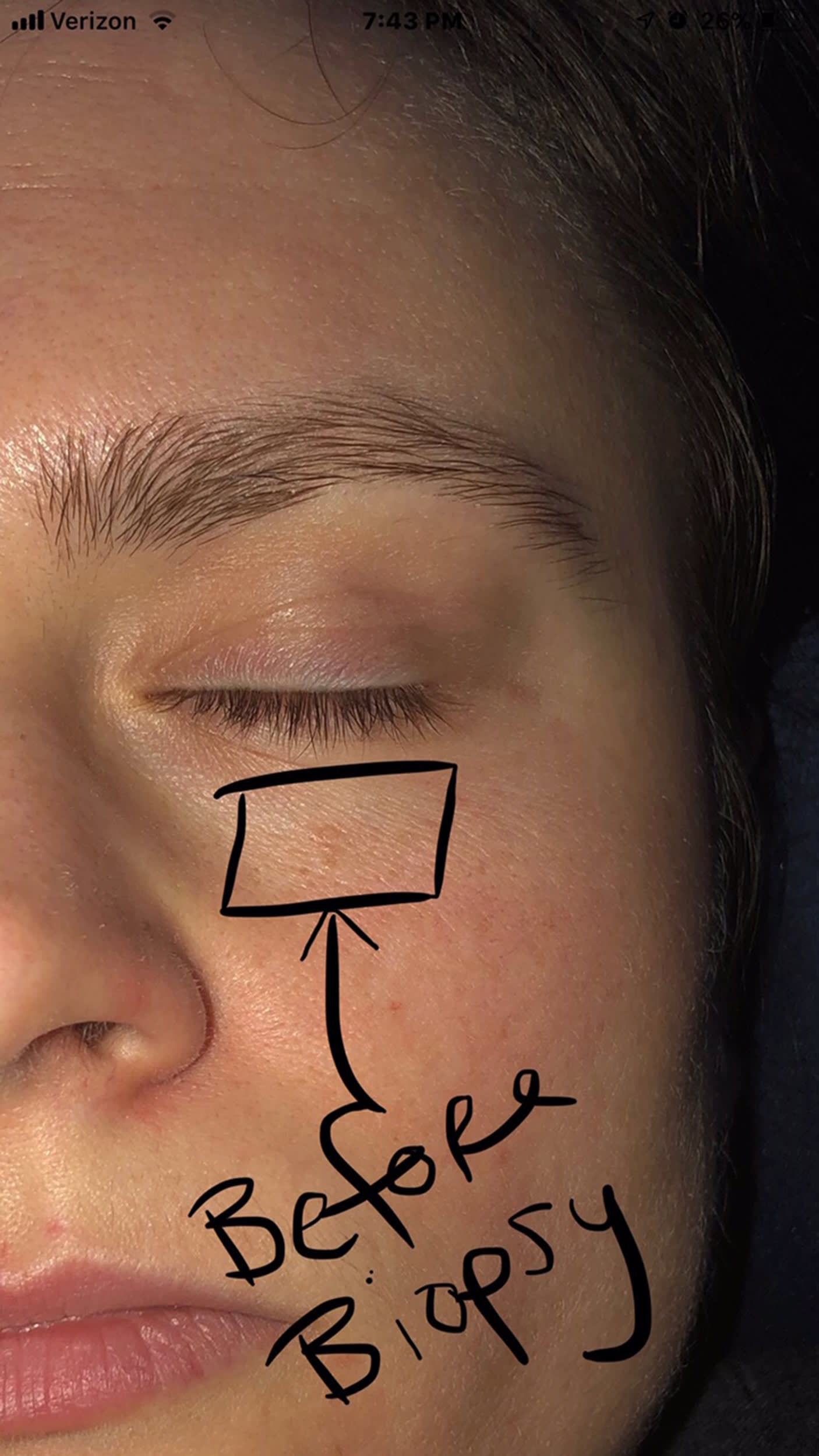 Skin Cancer Woman Discovers Basal Cell Carcinoma Near Eye