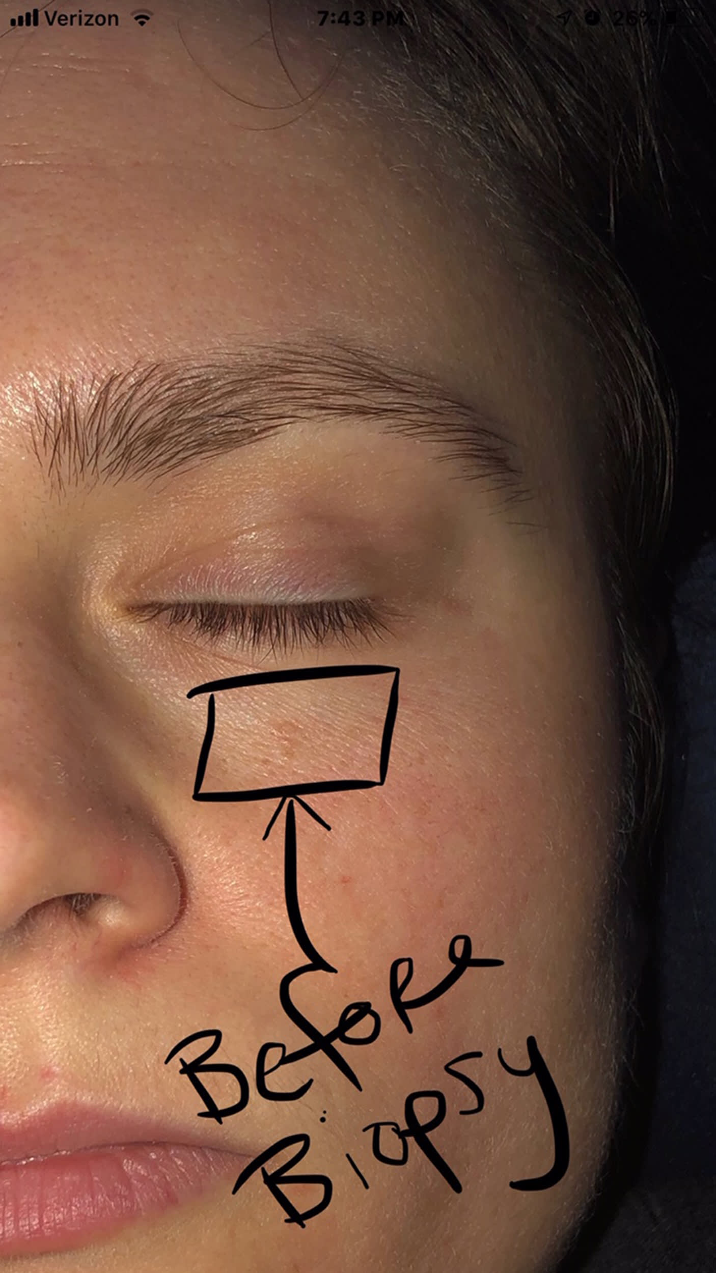 cancer: Woman discovers basal cell carcinoma near eye