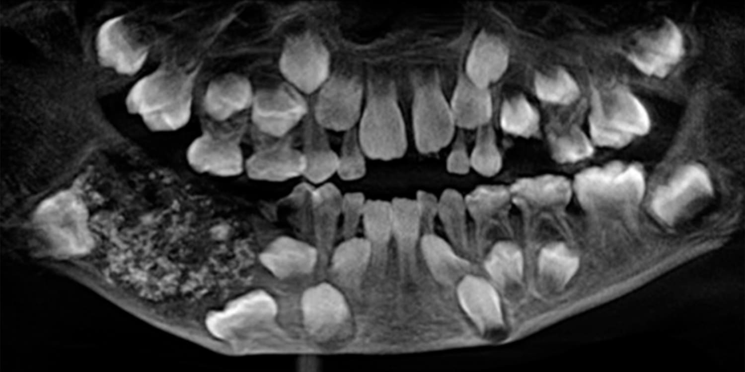 фото выбитых зубов