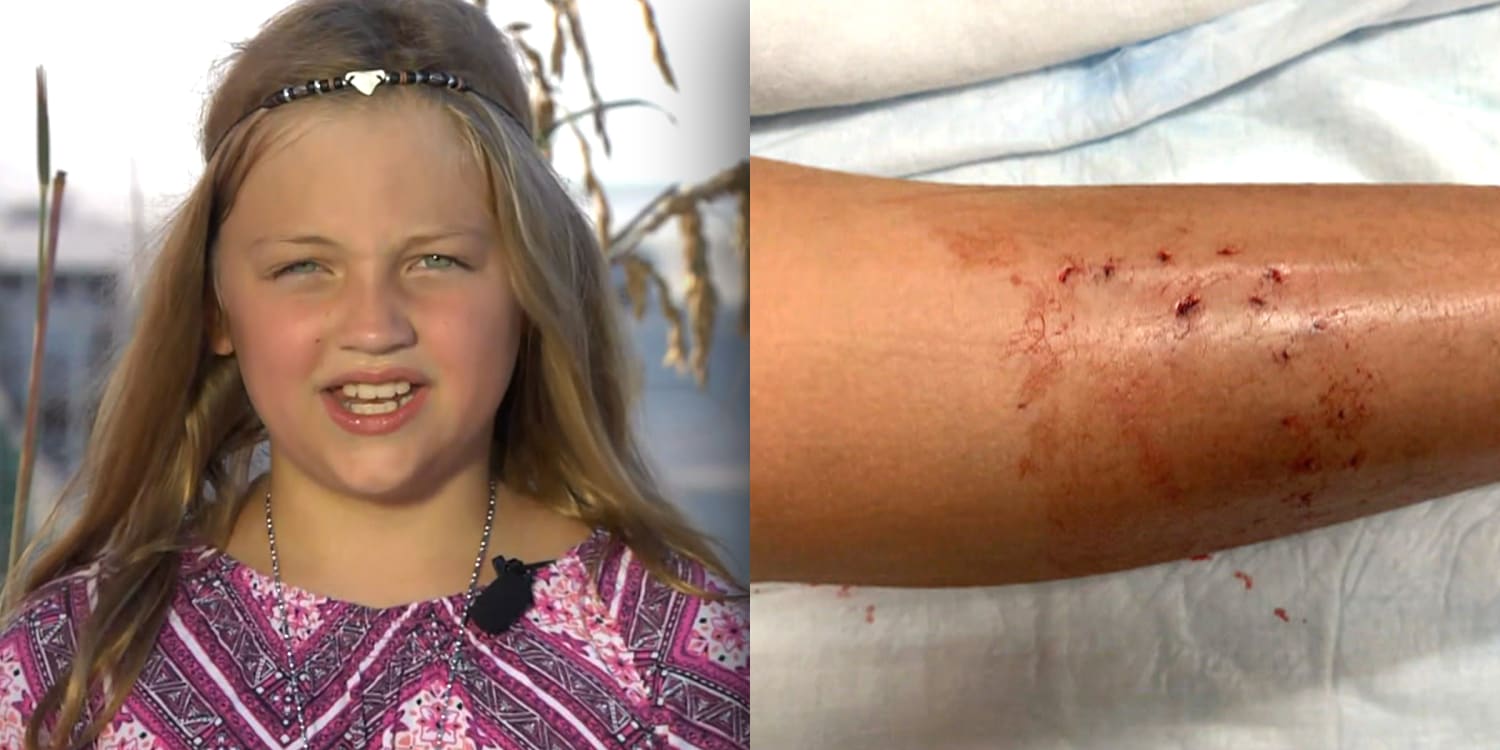 9 Year Old Girl Details Shark Attacked Off New Smyrna Beach