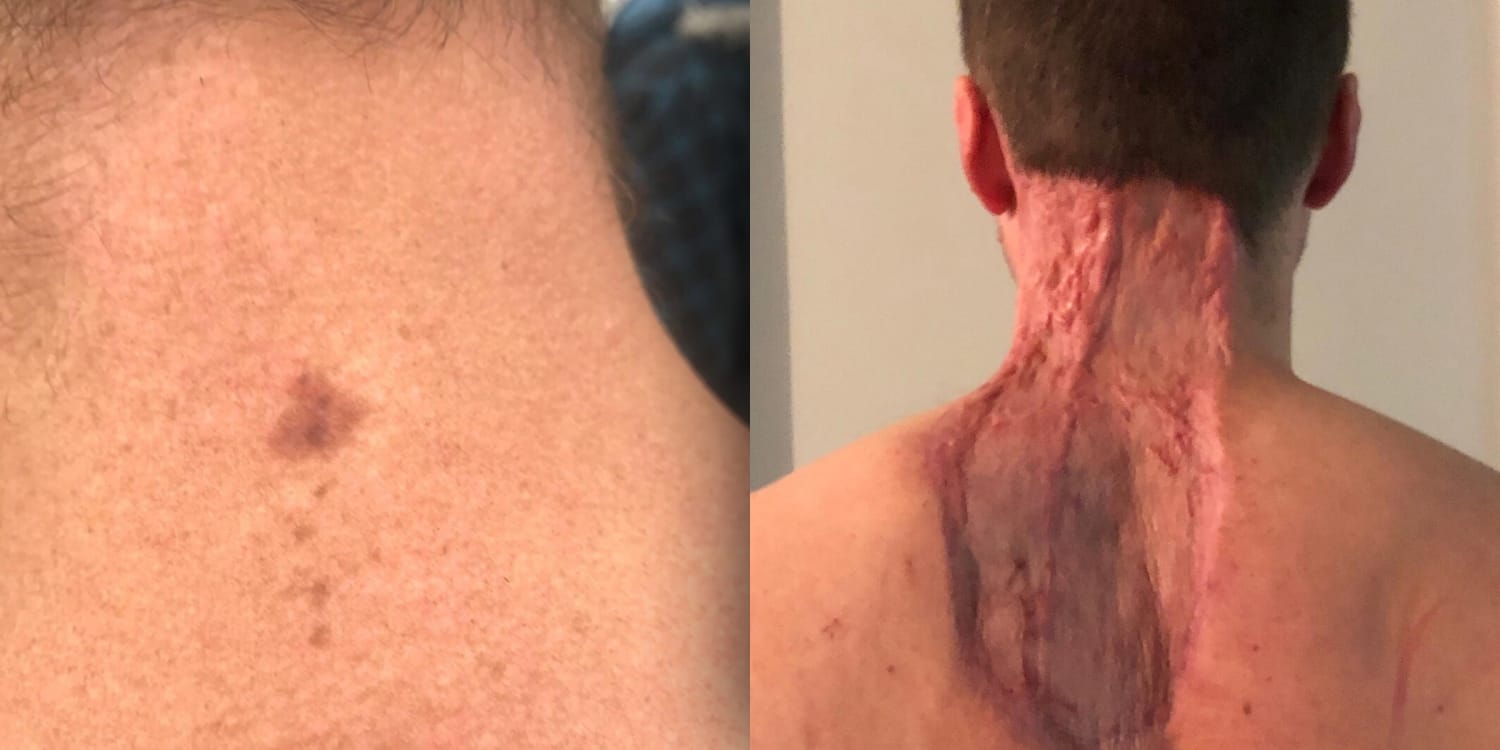Neck Spot Diagnosed As Skin Cancer Man Warns About Mole