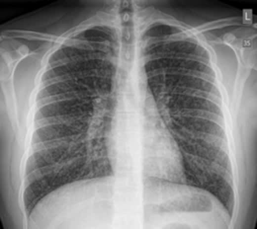 can smoking cigarettes cause popcorn lung What Is and Why Is It Being Discussed? E-cigarettes can cause popcorn lung