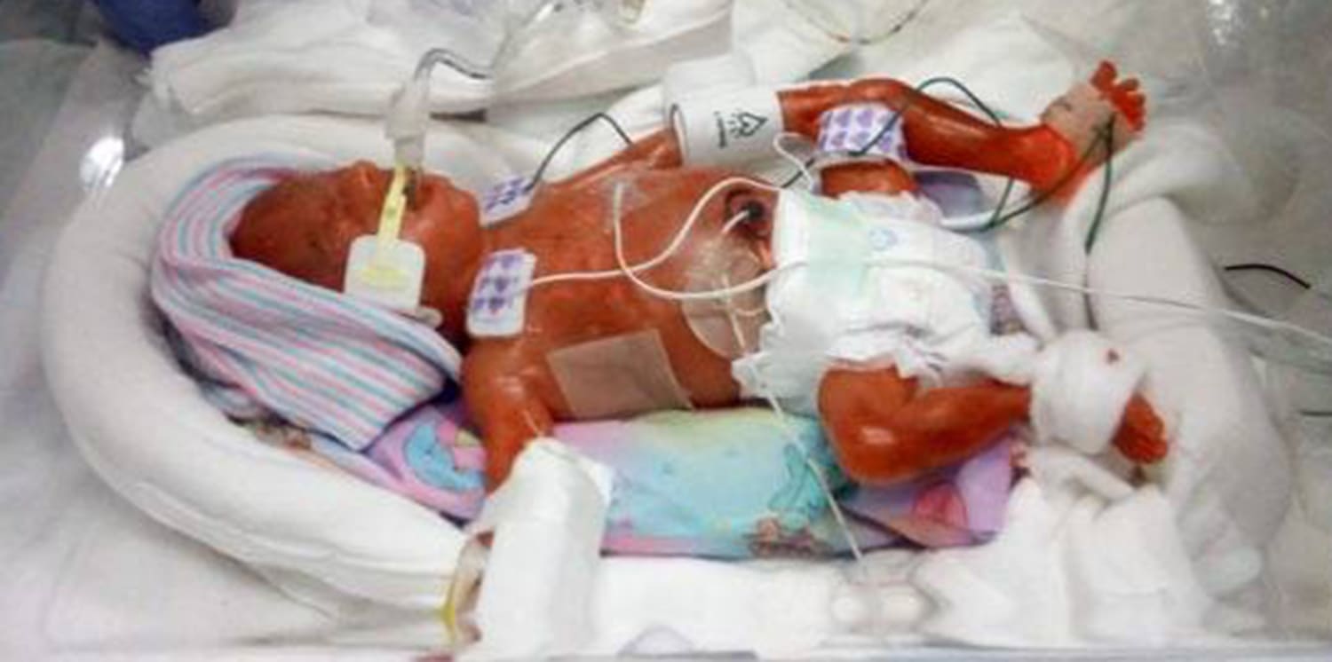 Born At 22 Weeks Twin Micropreemies Among Youngest To Survive