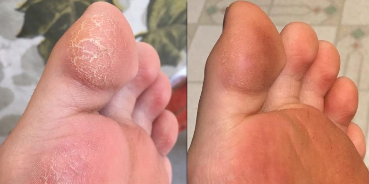 Amazon customers love this foot cream for dry, cracked skin