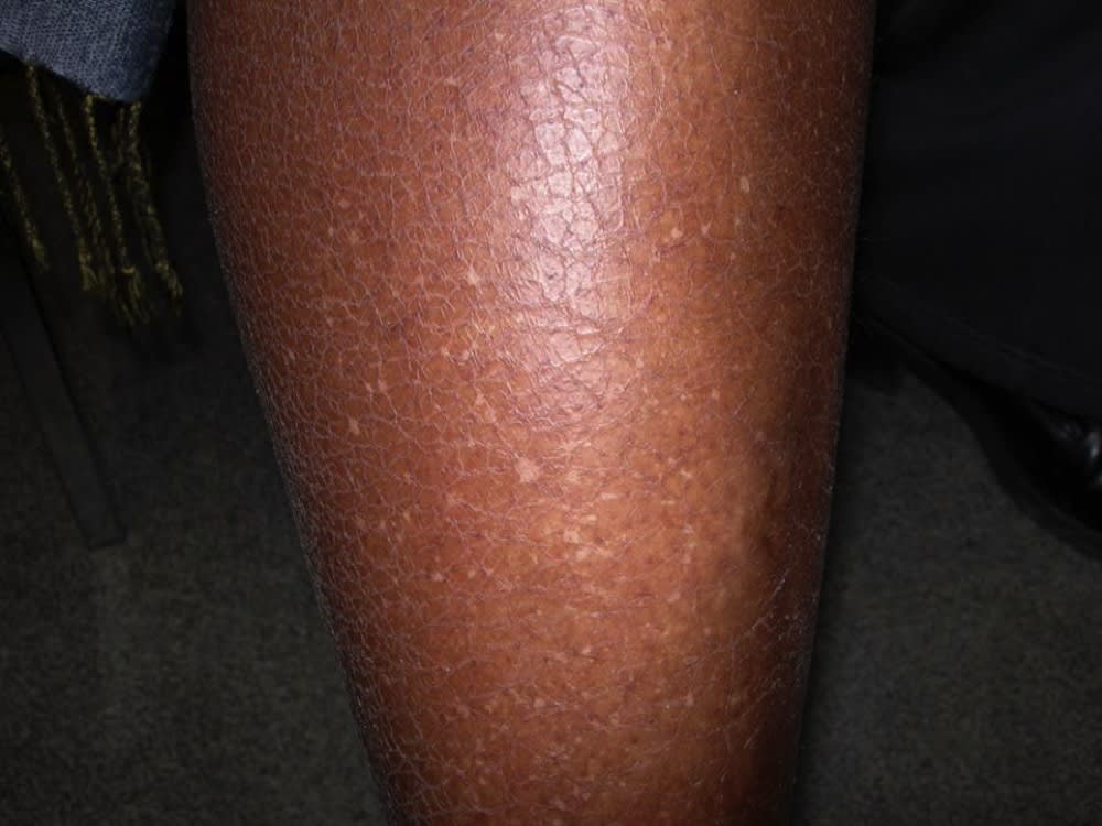 What are the white spots on my arms? Idiopathic guttate hypomelanosis  explained