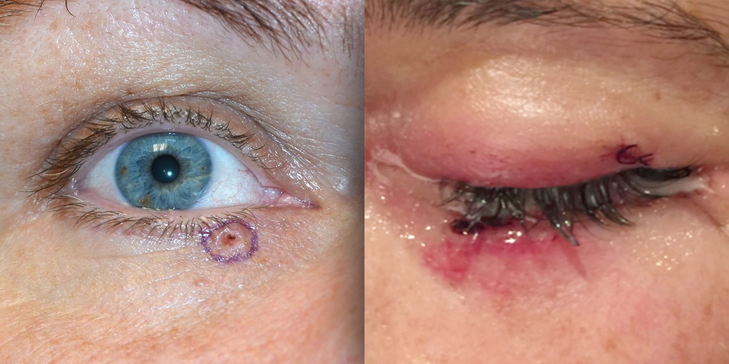 Skin Cancer on Eyelid 