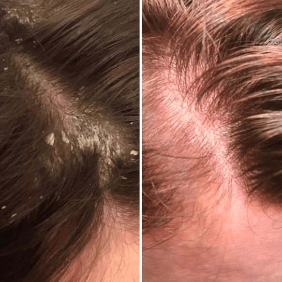 Here's what dermatologists have to say Nizoral A-D Shampoo