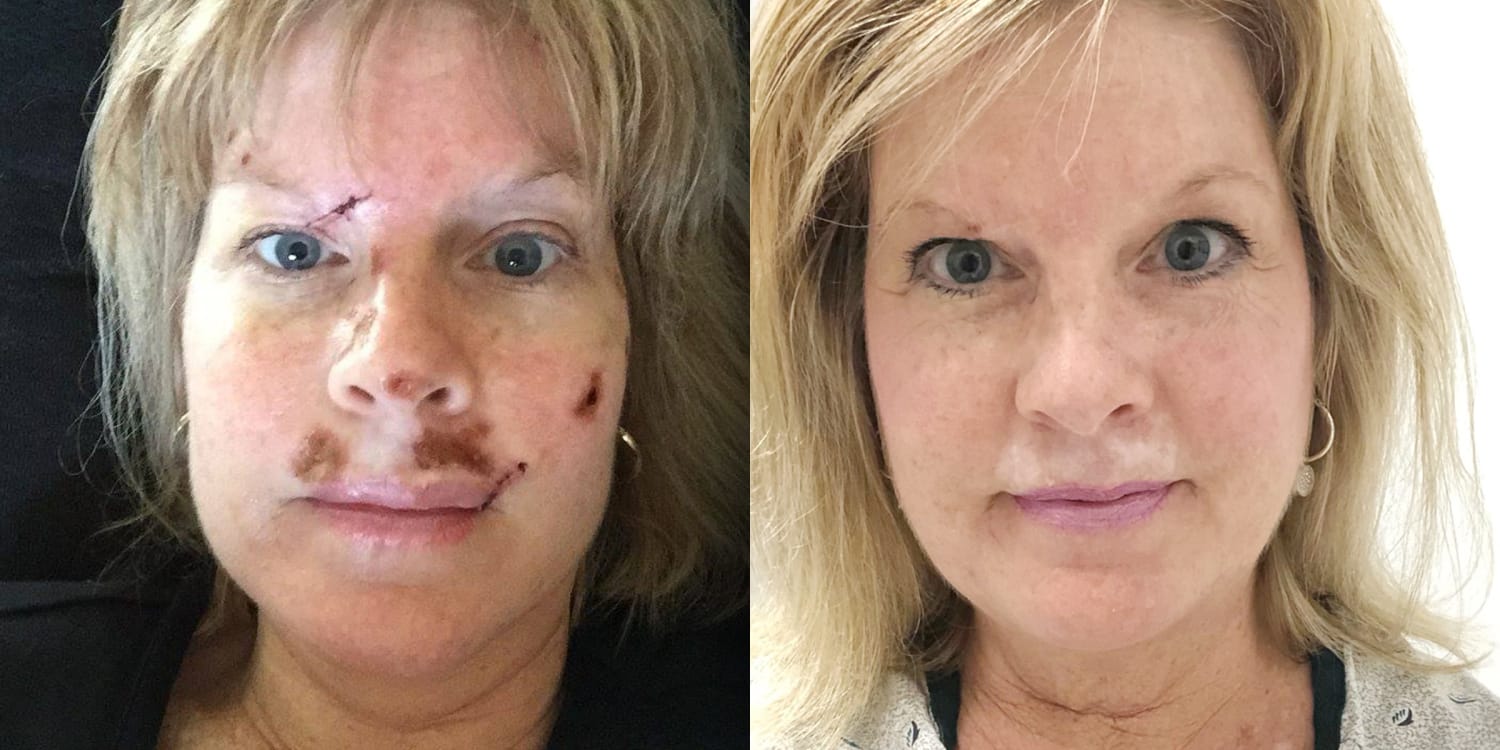 How To Prevent Skin Cancer Woman Has 40 Spots Removed Over 25 Years After Tanning