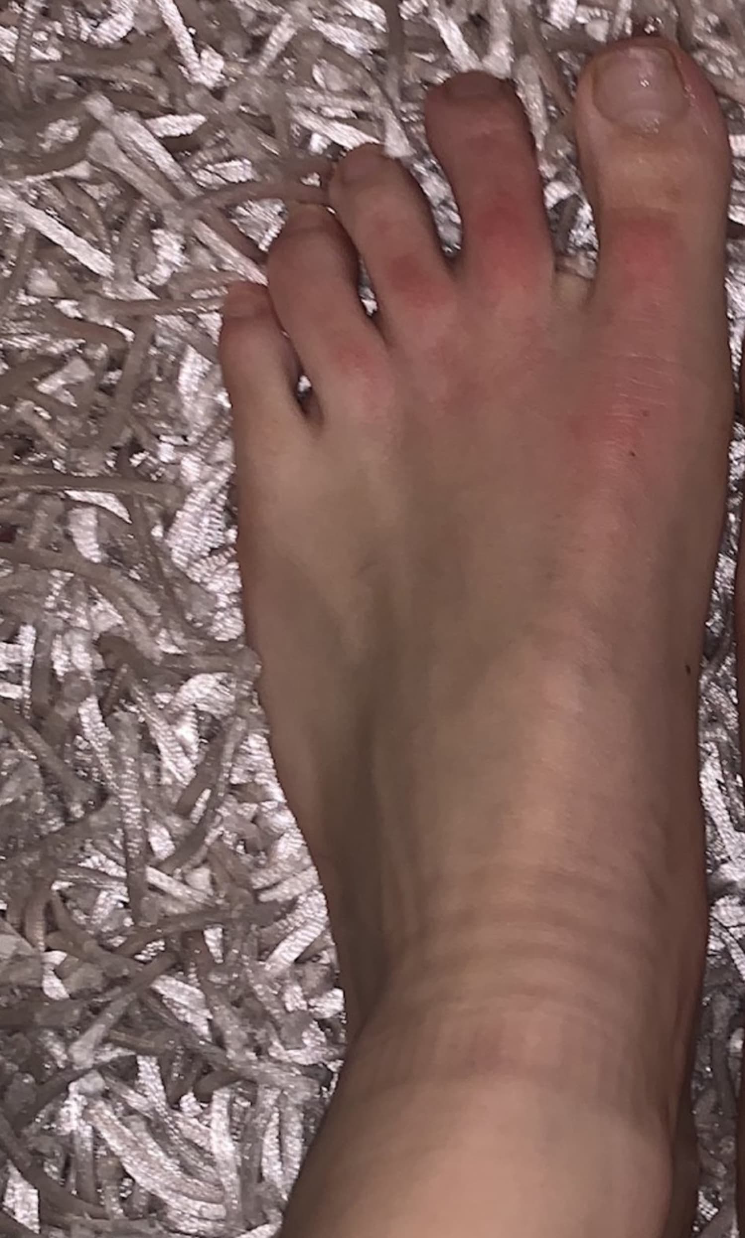 Covid Toes: Dermatologists podiatrists explain toes