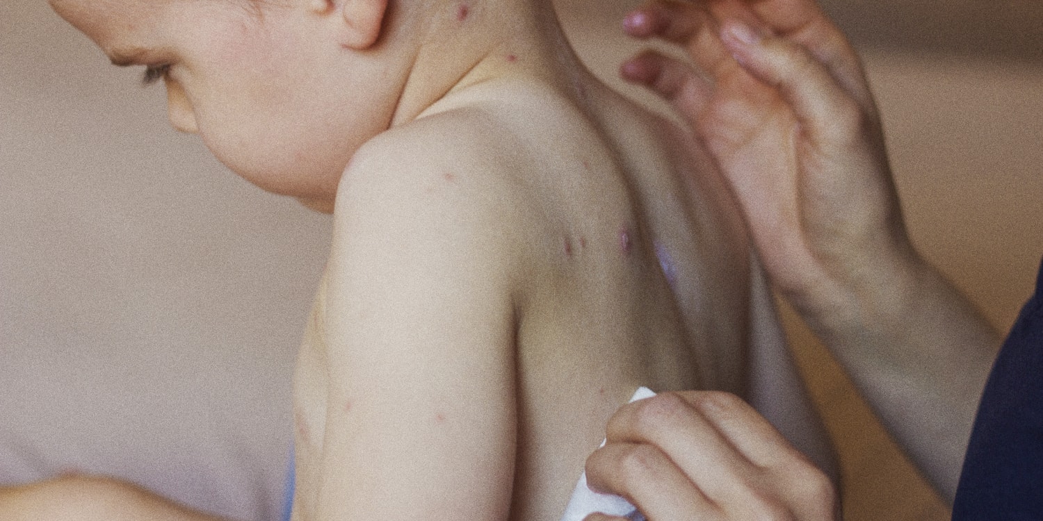 Cook Children's - A case of the measles has been confirmed