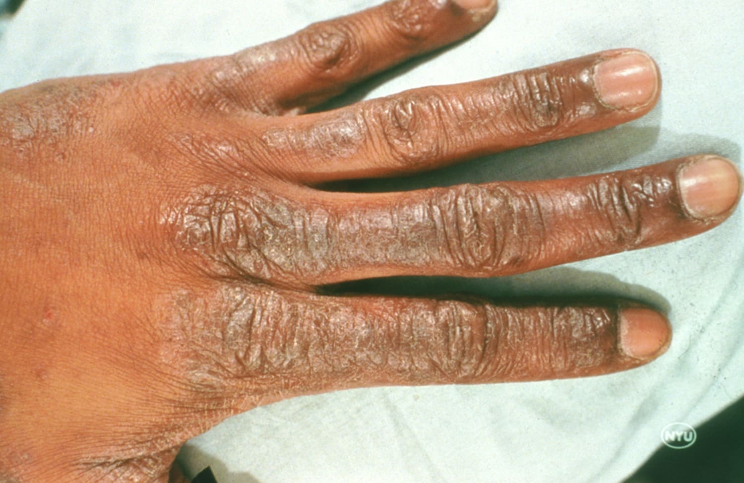 contact dermatitis fingers