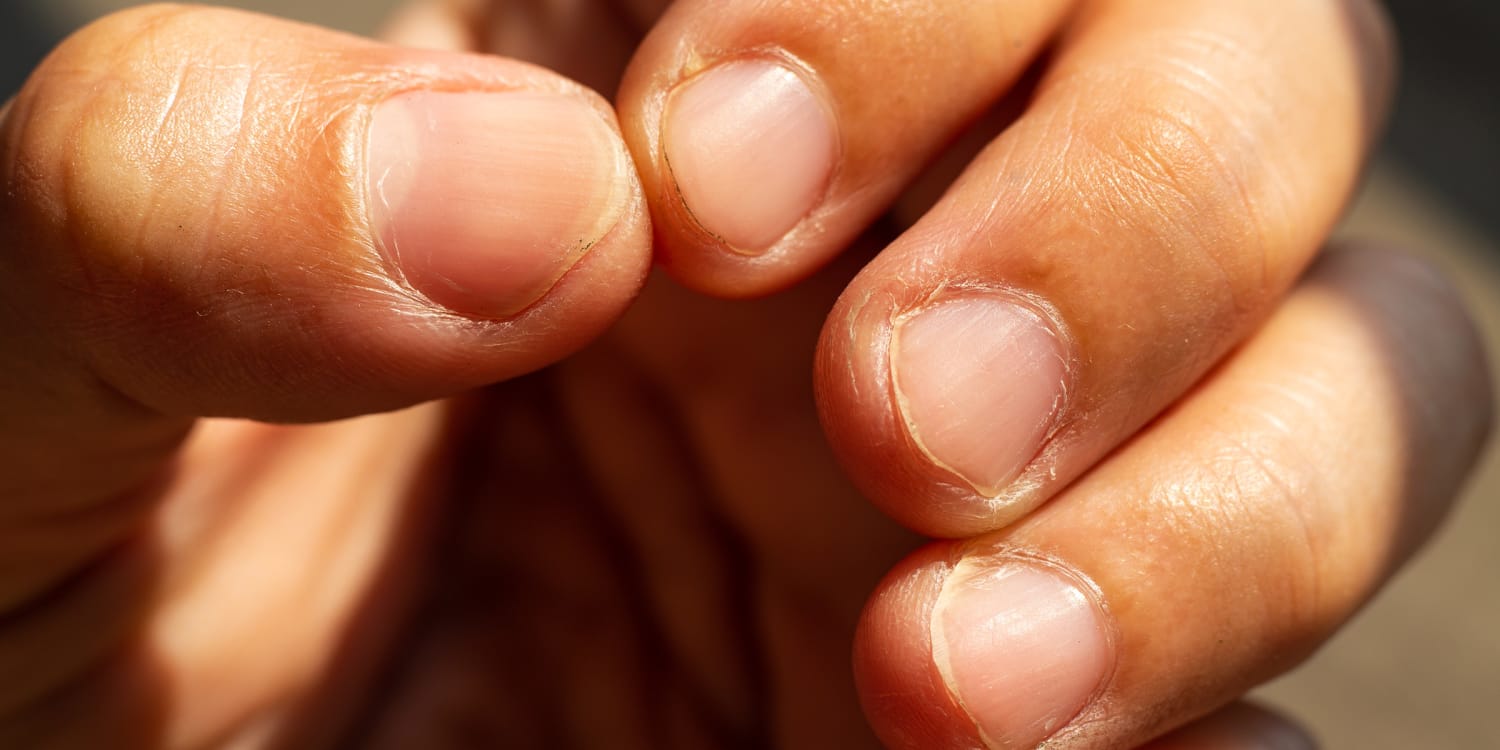 Premium Photo | Nails with white spots on yellow background. leukonychia,  calcium deficit.