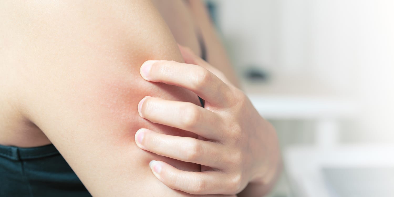 Red and itchy? How to identify 5 common summer rashes
