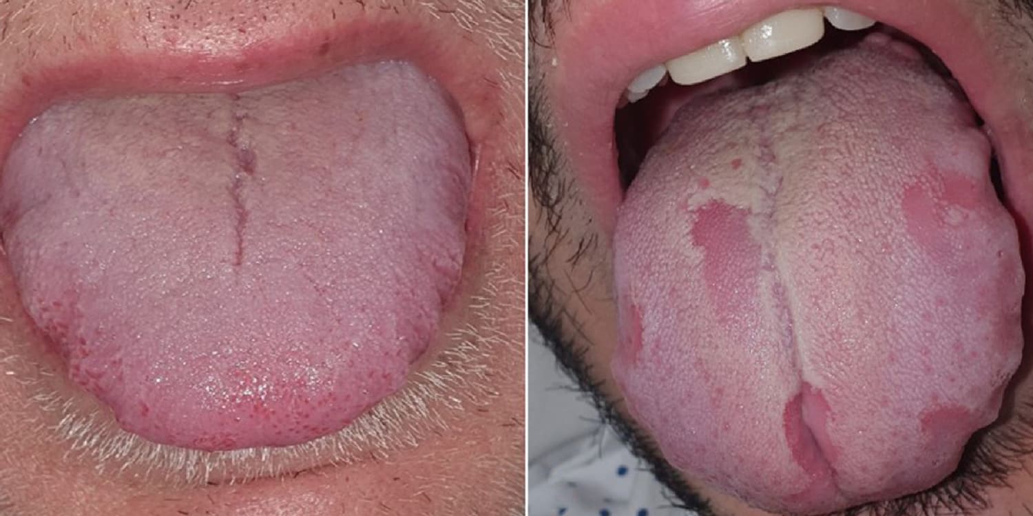 What Is Covid Tongue Swollen Sore Tongue May Be Possible Coronavirus Symptom