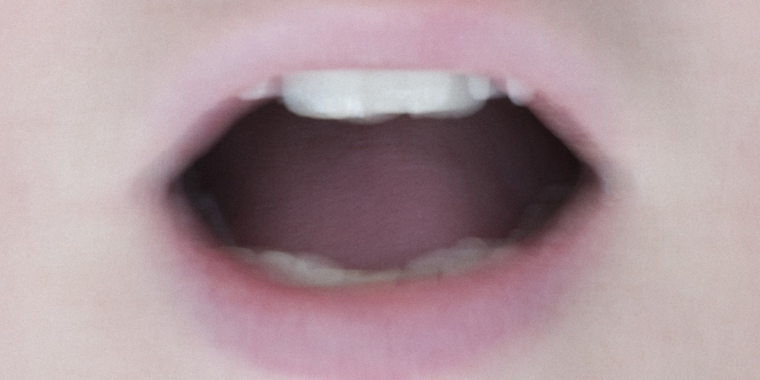 Middle of tongue split in Fissured Tongue: