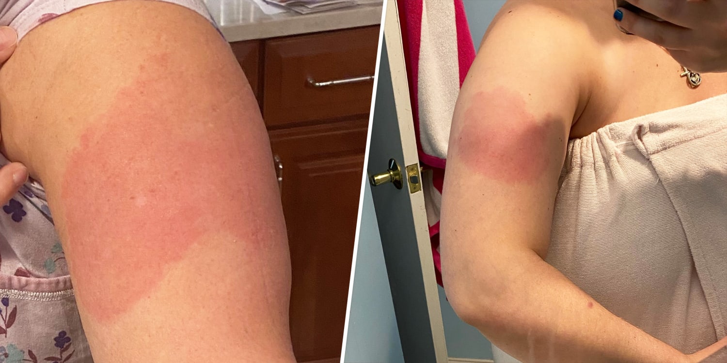 Covid 19 Vaccine Delayed Skin Reaction Redness Rash A Week After Shot