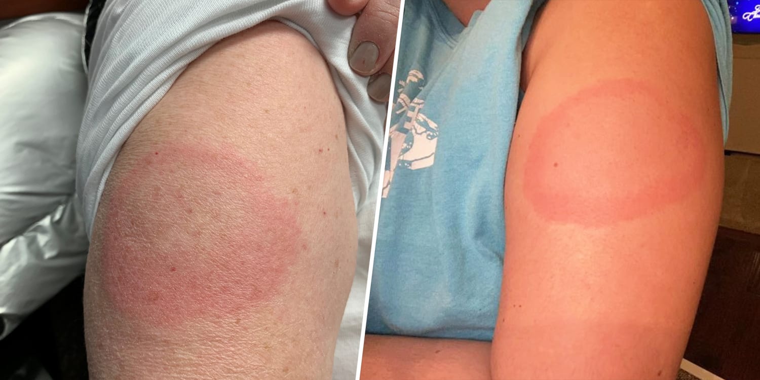 Covid 19 Vaccine Delayed Skin Reaction Redness Rash A Week After Shot