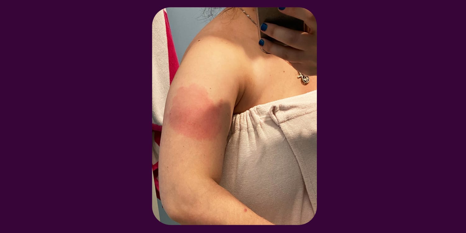 Covid 19 Vaccine Delayed Skin Reaction Redness Rash A Week After Shot