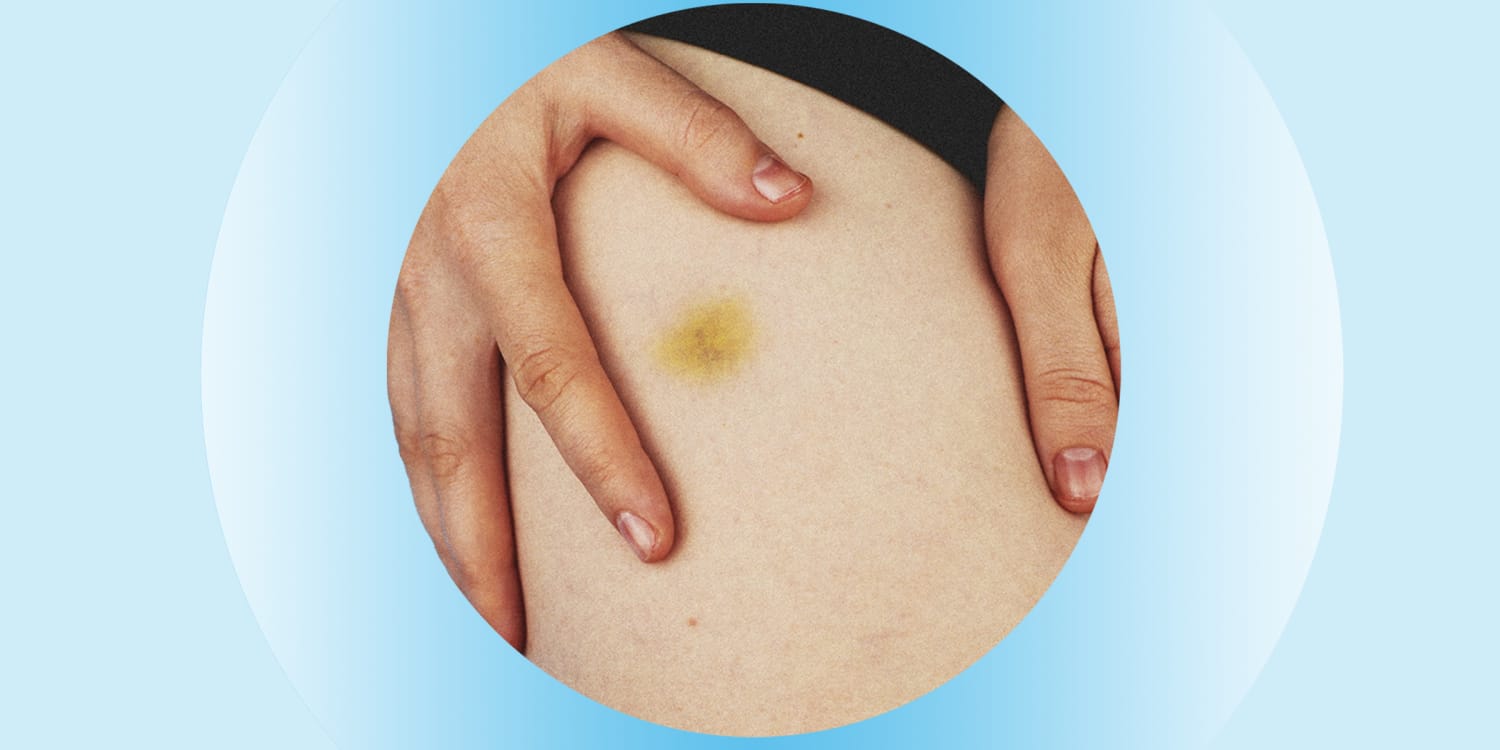 Why do you bruise easily? What you need to know - TODAY