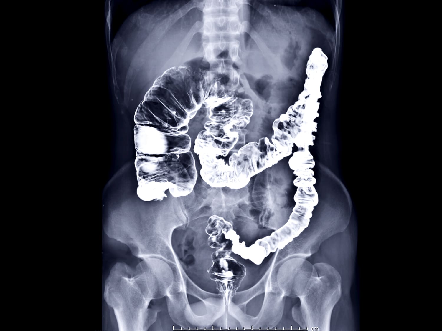 rectal cancer x ray