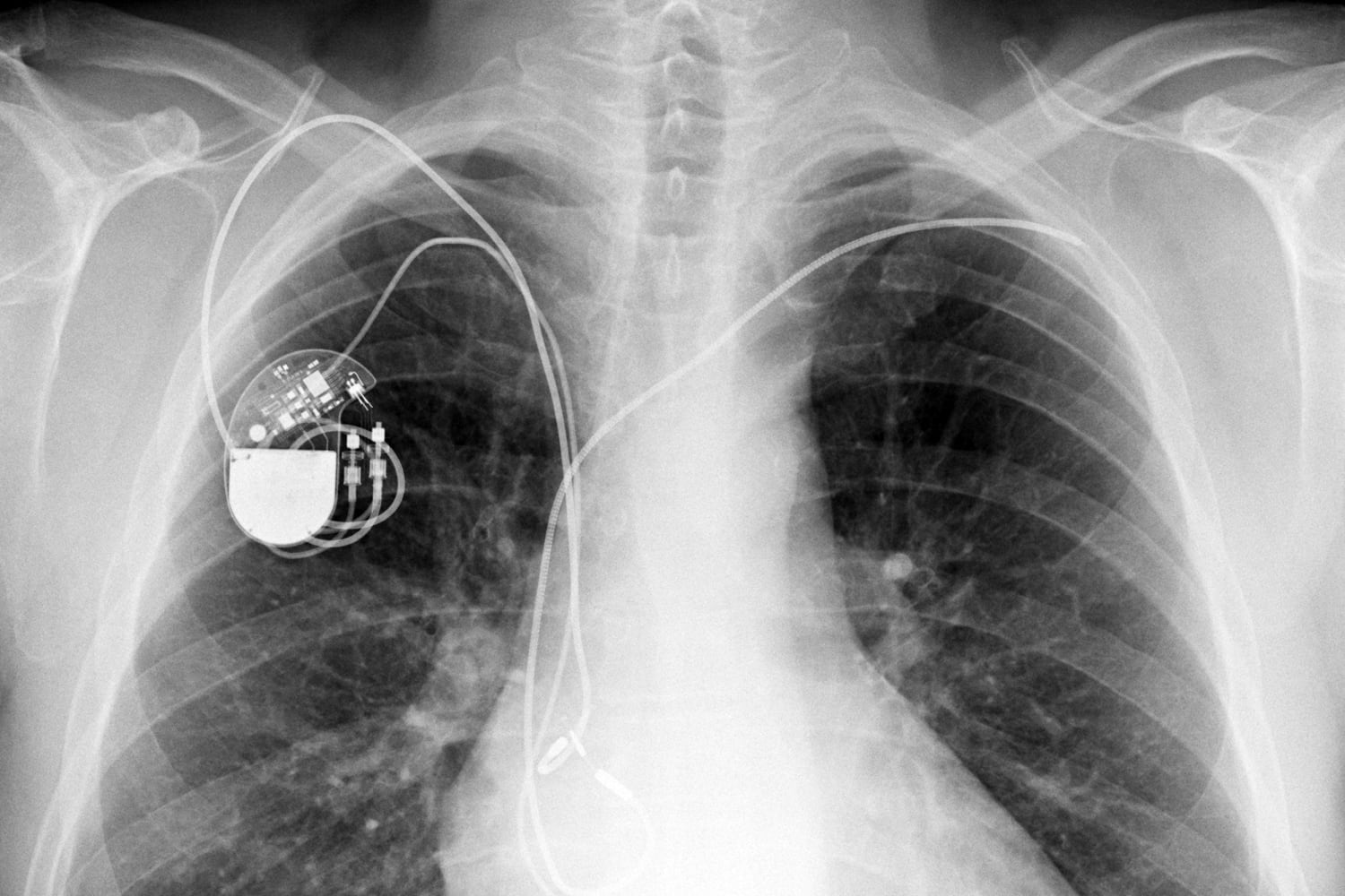 Pacemaker. Электрокардиостимулятор имплантируемый. Двухкамерный кардиостимулятор. Кардиостимулятор на рентгене. Рентген грудной клетки с кардиостимулятором.